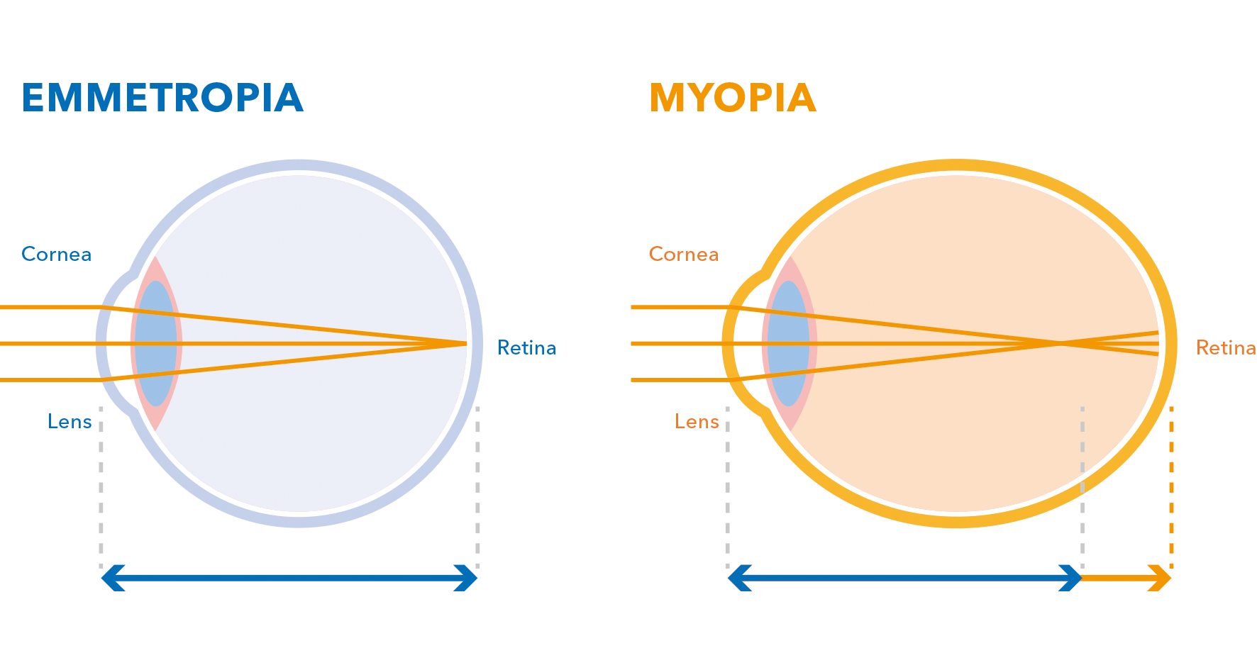 MYOPIA1