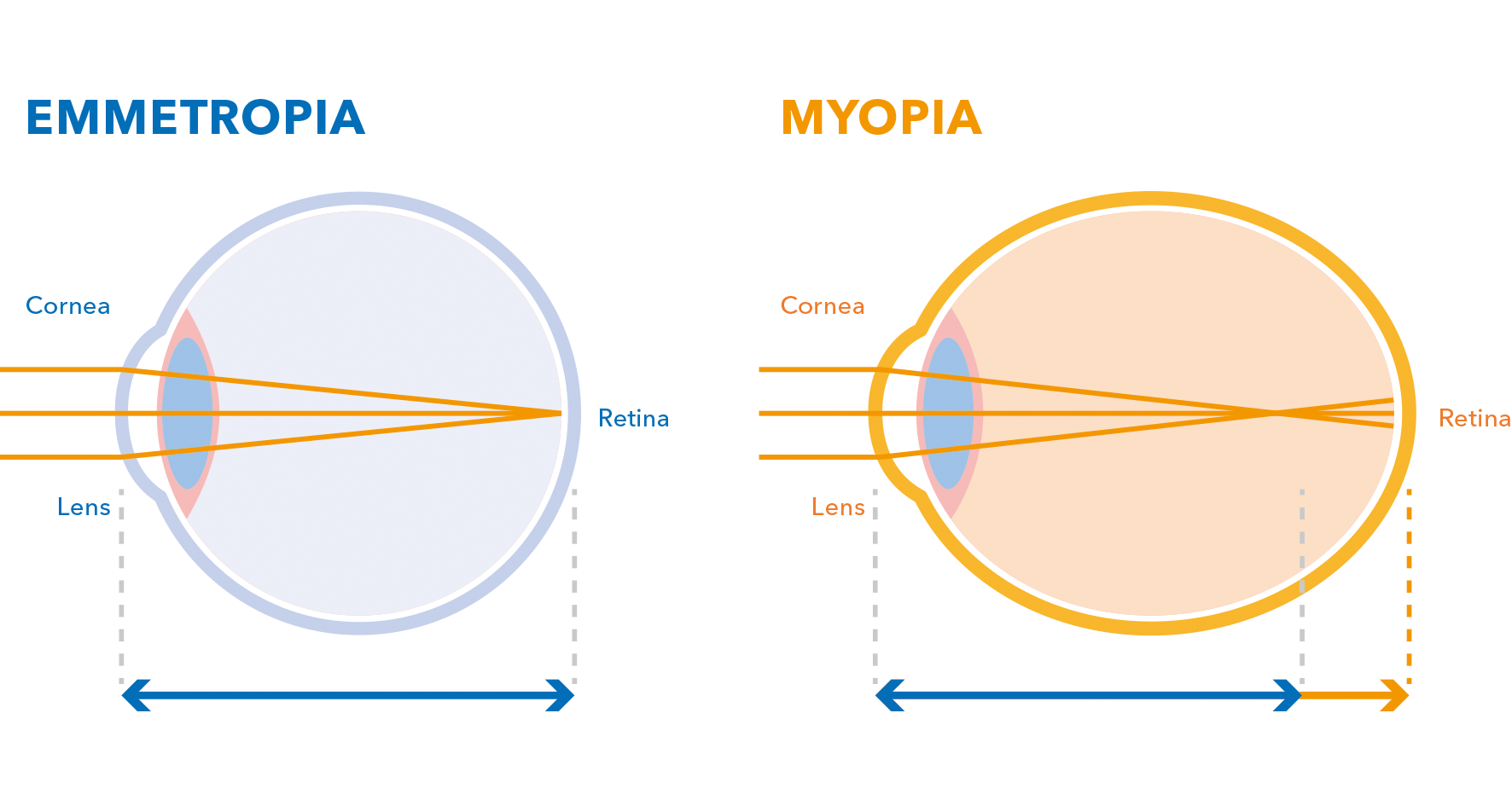 MYOPIA1 MYOPIA1